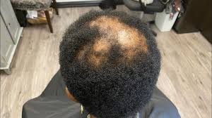 Thinning Hair... Answers